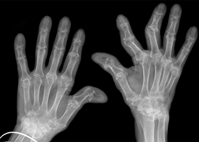Zelfs patiënten met ernstig gebogen vingers als gevolg van Reumatoïde artritis kunnen een optimale behandeling krijgen met een FingerKIt implantaat. (foto: iStock/WILLSIE)